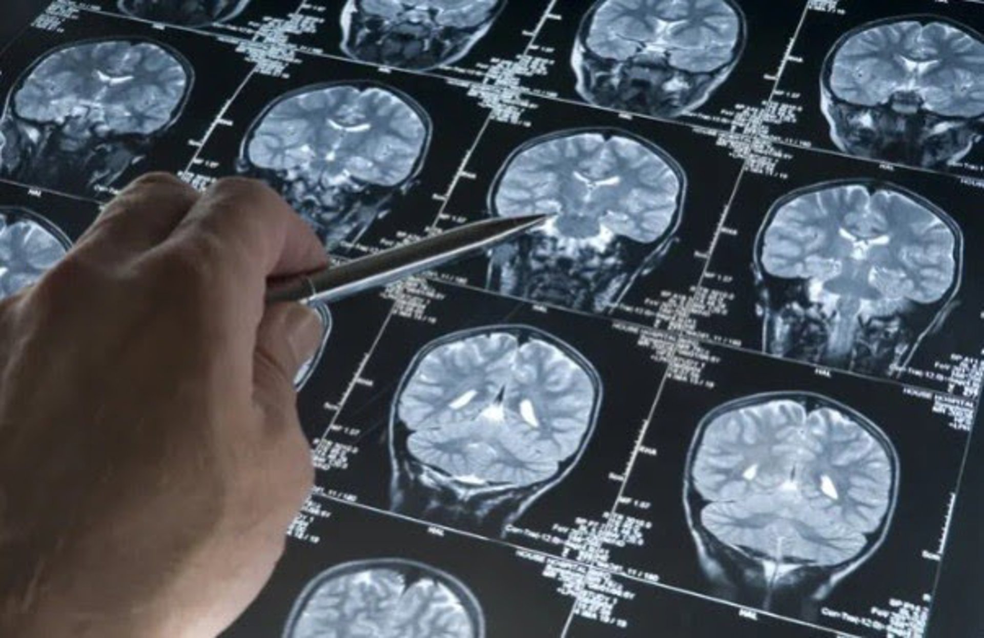 Un estudio señala que una molécula logra «reprogramar» las defensas del cerebro frente al alzhéimer